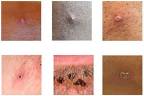 This file handout picture made available by the UK Health Security Agency (UKHSA) on June 22, 2022 shows a collage of monkeypox rash lesions at an undisclosed date and location. Handout/UK HEALTH SECURITY AGENCY/AFPpix