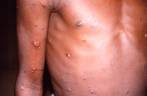 An image created during an investigation into an outbreak of monkeypox, which took place in the Democratic Republic of the Congo, 1996 to 1997, shows the arms and torso of a patient with skin lesions due to monkeypox/REUTERSPix
