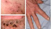 (FILES) In this file handout photo taken on June 22, 2022 made available by the UK Health Security Agency (UKHSA) shows a collage of monkeypox rash lesions at an undisclosed date and location. AFPPIX