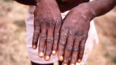 FILE PHOTO: An image created during an investigation into an outbreak of monkeypox, which took place in the Democratic Republic of the Congo (DRC), 1996 to 1997, shows the hands of a patient with a rash due to monkeypox, in this undated image obtained by Reuters on May 18, 2022. REUTERSPIX