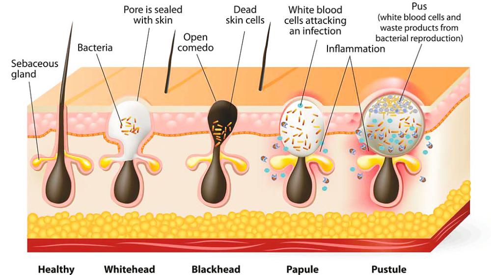 $!A poor skin micobiome can lead to one of the most common skin condition, acne.
