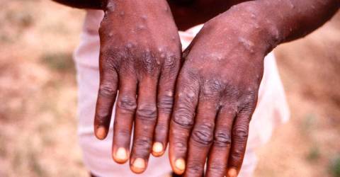Monkeypox: Get vaccinated before travelling overseas