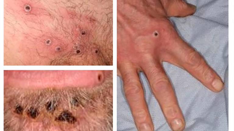 (FILES) In this file handout photo taken on June 22, 2022 made available by the UK Health Security Agency (UKHSA) shows a collage of monkeypox rash lesions at an undisclosed date and location. AFPPIX