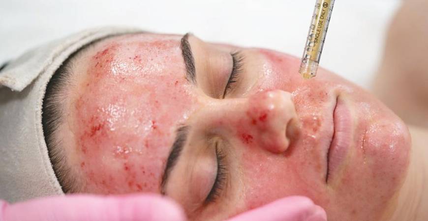 Drops of PRP will be applied on the face during the microneedling process, stimulating the body’s natural healing properties. – RN Aesthetics