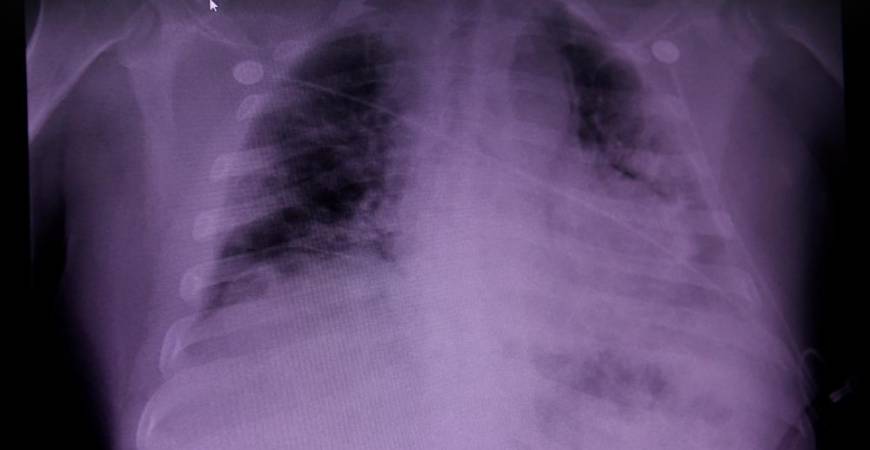 FILE PHOTO: An X-ray of a COVID-19 patient’s lungs at United Memorial Medical Center in Houston, Texas, U.S., July 10, 2020. REUTERS/Callaghan O’Hare/File Photo
